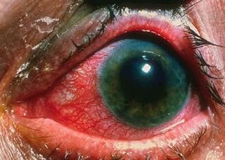 สภาพดวงตา ของผู้ป่วยต้อหิน