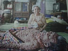 นายอภิชัย ภูริวัฒนานน อายุ 84 ปี ป่วยโรคท้าวแสนปมและอัมพาต อาศัยอยู่กับภรรยา อายุ 85