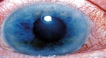 ลักษณะอาการดวงตาของผู้ป่วยเป็นโรคต้อหิน