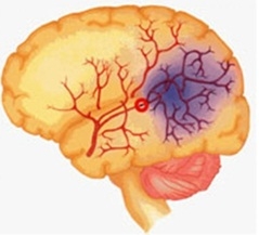 สื่อทางการแพทย์ แสดงภาพหลอดเลือดสมองอุดตัน