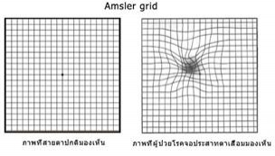 Amsler grid ระหว่างภาพที่สายตาปกติมองเห็นและภาพที่ผู้ป่วยโรคจอประสาทตาเสื่อมมองเห็น