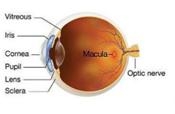 สื่อทางการแพทย์ ภาพโมเดลดวงตาของผู้ป่วยโรคจอประสาทตาเสื่อม