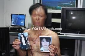 นายคิน โส อายุ 38 ปี สัญชาติพม่า เข้าแจ้งความถูกภรรยาสาดน้ำกรดเข้าที่ใบหน้า