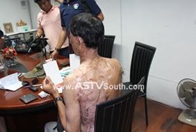 นายคิน โส อายุ 38 ปี สัญชาติพม่า เข้าแจ้งความถูกภรรยาสาดน้ำกรดเข้าที่ใบหน้า