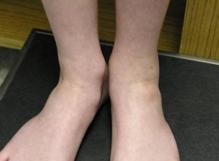 ข้อเท้าของเด็กที่มีอาการข้ออักเสบ