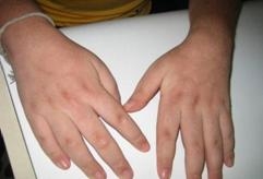 มือของเด้กที่มีอาการข้ออักเสบ