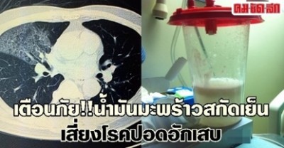 น้ำมันมะพร้าวสกัดเย็น...เสี่ยงโรคปอดอักเสบ