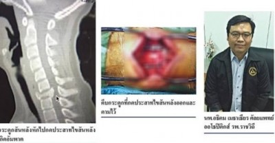 การผ่าตัดกระดูกสันหลังหัก