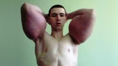 คลั่งป๊อปอายถึงเสี่ยงพิการ