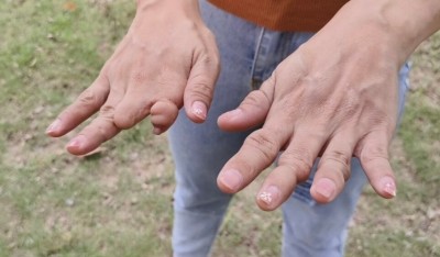 สาวพิการฝันสลายสั่งทำนิ้วมือ-นิ้วเท้าเทียม ถูกเชิดเงินหนีลอยนวล