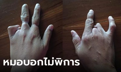 สาวข้องใจ นิ้วมือผิดปกติแต่กำเนิด แต่ทำบัตรคนพิการไม่ได้ หมอบอกไม่เข้าเกณฑ์