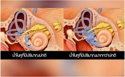 ภาพประกอบน้ำในหูไม่เท่ากัน