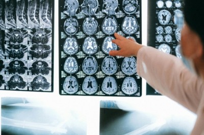 ‘สโตรกสมอง’ คร่าชีวิตคนไทยทุก 10 นาที รู้ทัน BEFAST ลดเสี่ยงพิการ-เสียชีวิต