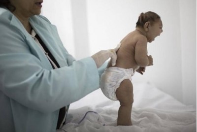 ไวรัสซิกาเป็นสาเหตุที่ทำให้ทารกมีศีรษะเล็กผิดปกติ