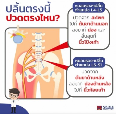 ทำความรู้จัก! ตำแหน่งปลิ้นหมอนรองกระดูกส่วนเอว แพทย์แนะรักษาเร็วก่อนพิการ