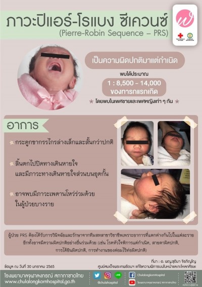 ภาวะปีแอร์-โรแบง ซีเควนซ์ (Pierre-Robin Sequence -PRS)