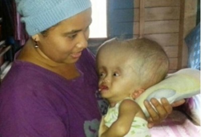 นางนุสรา อาดัม อายุ 35 ปี มารดา ที่กำลังดูแล ด.ช. อามีน นาเงิน อายุ 1 ปี 6 เดือน ป่วยเป็นโรคหัวแตงโม หรือ สมองบวม