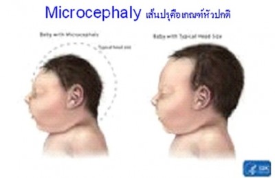 Microcephaly ไมโครเซฟาลี (ศีรษะเล็ก)