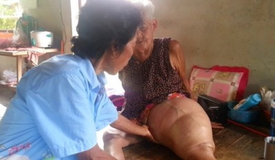 นางแสวง คงแจ้ง อายุ 88 ปี พิการเดินไม่ได้ และขาบวมโตเท่าลูกบาสเกตบอล