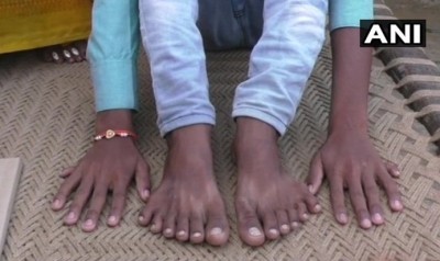 เด็กอินเดียพิการมี 12 นิ้วมือ 12 นิ้วเท้า ถูกบรรดาญาติไล่จับบูชายัญ หวังร่ำรวย