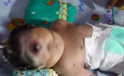 ทารกอินโดฯ มีดวงตาข้างเดียว เสียชีวิตหลังดูโลกเพียง 7 ชม.