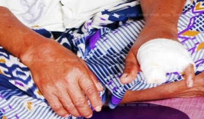 เฒ่าสตูลครวญ ถูกตัดนิ้วมือ กลายเป็นคนพิการ หลังหมอฉีดยาเข้าง่ามนิ้วจนเน่า