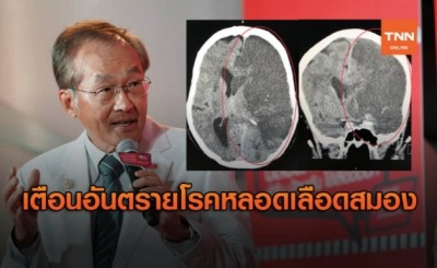 หมอมนูญ เตือน "โรคหลอดเลือดสมอง" คร่าชีวิตคนไทยอันดับ 3