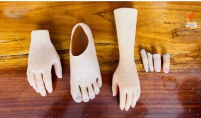 "มือ-นิ้ว-เท้า" เทียมเพื่อทดแทน สร้างความมั่นใจ เหมือนไม่พิการ